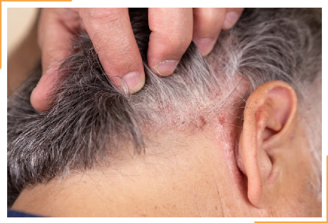 Person looking at a skin rash behind ear wondering if it is psoriasis