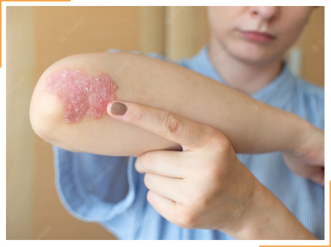 young person unsure of skin rash on elbow, wondering if it is psoriasis